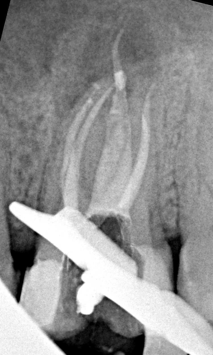 RTG zęba 26 po leczeniu kanałowym pod mikroskopem we Wrocławiu — cztery kanały wypełnione do wierzchołka, CBCT (SkyDent)