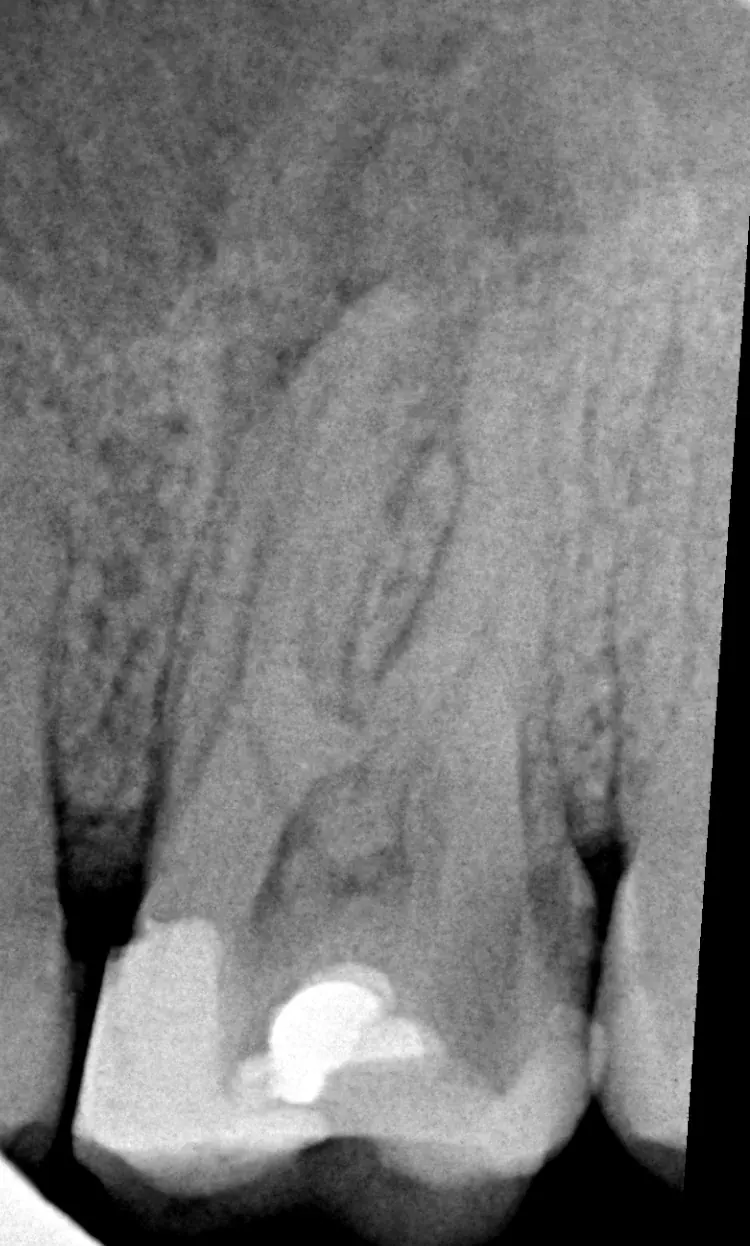 RTG zęba 26 przed leczeniem kanałowym we Wrocławiu — górna szóstka, diagnostyka anatomii kanałów (SkyDent)