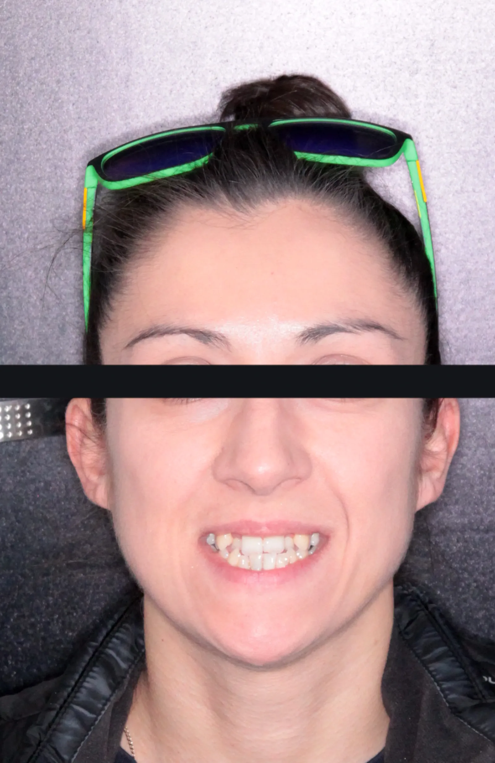 Przed: brak górnej szóstki i stłoczenia — alternatywa ortodontyczna dla implantu, Wrocław SkyDent