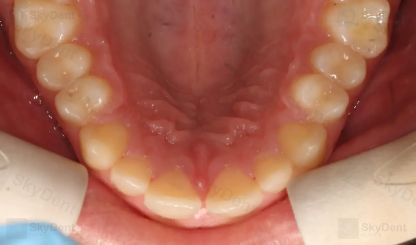 Łuk górny przed leczeniem — diastema między jedynkami, ortodoncja Wrocław SkyDent