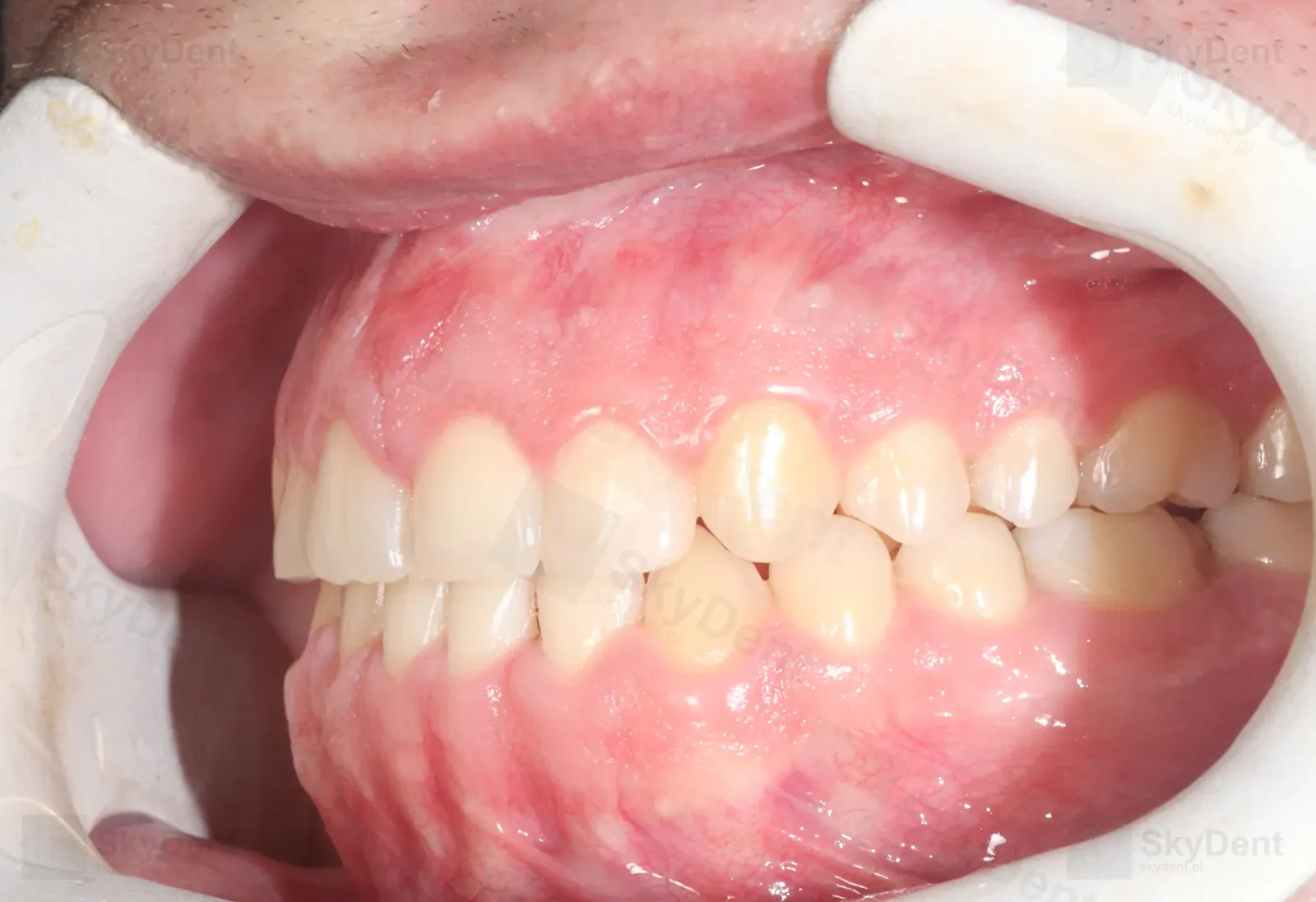 Ujęcie z lewej po dystalizacji i aparacie stałym — zamknięta diastema, ortodoncja Wrocław SkyDent