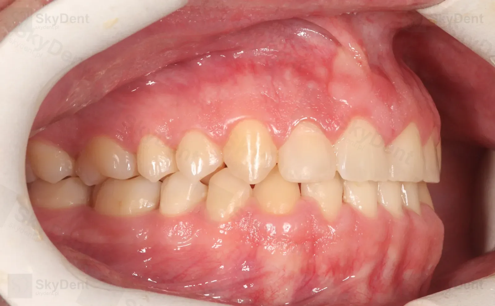Ujęcie z prawej po dystalizacji i aparacie stałym — zamknięta diastema, ortodoncja Wrocław SkyDent