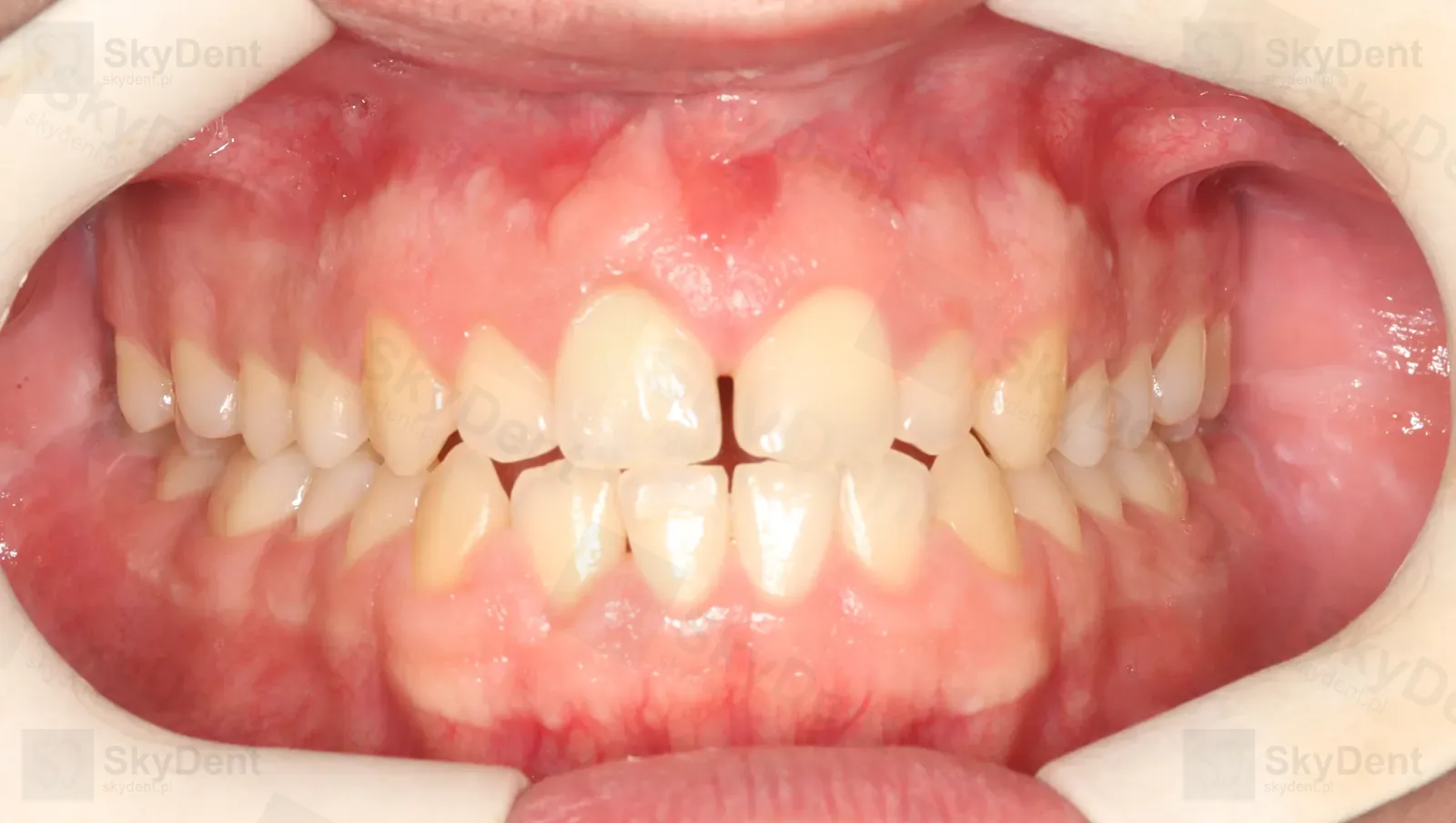 Zgryz przed dystalizacją — dolne siekacze uderzają o górne, diastema, ortodoncja Wrocław SkyDent