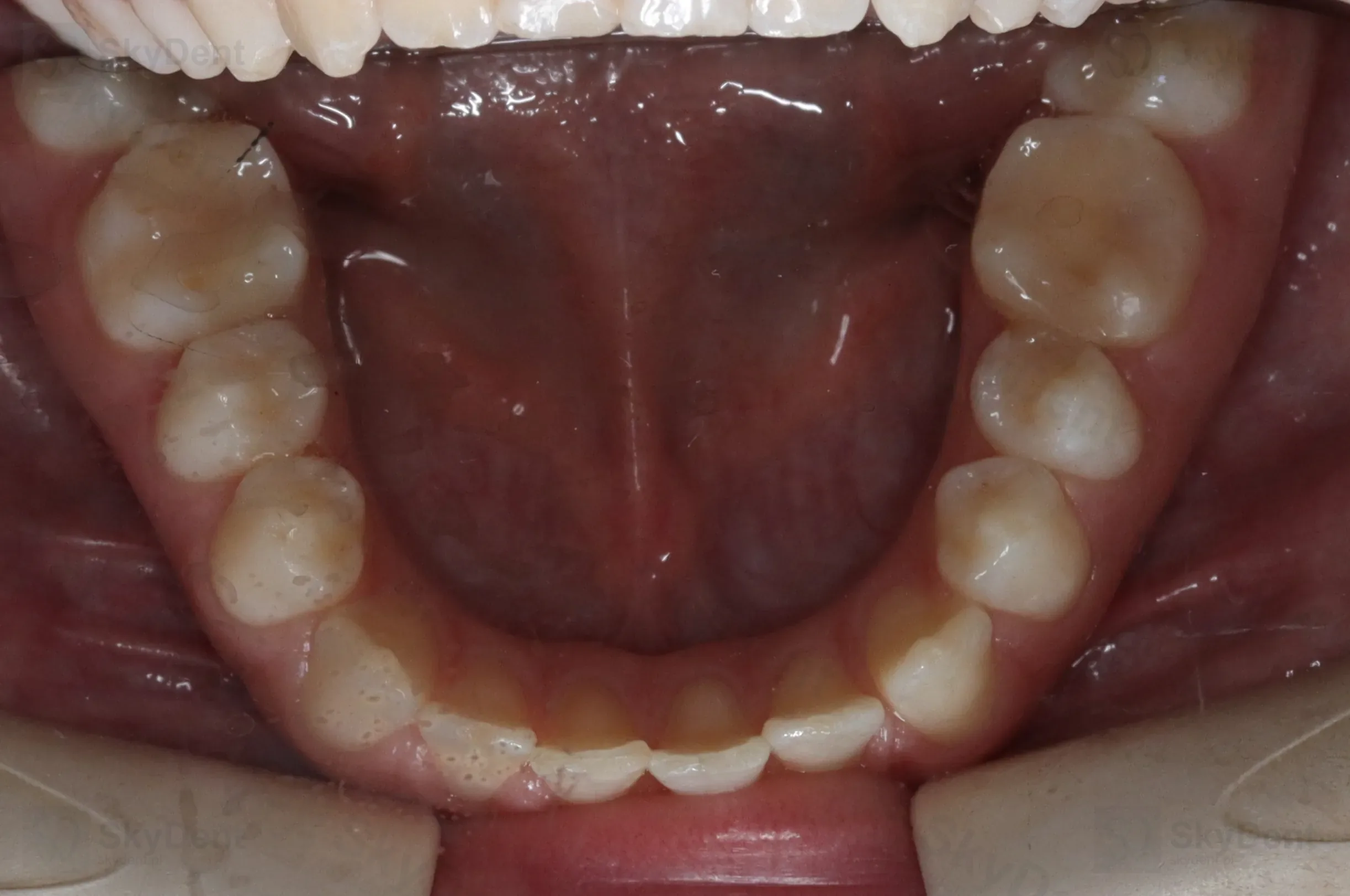 Łuk dolny przed leczeniem zgryzu otwartego na mikroimplantach — Wrocław SkyDent