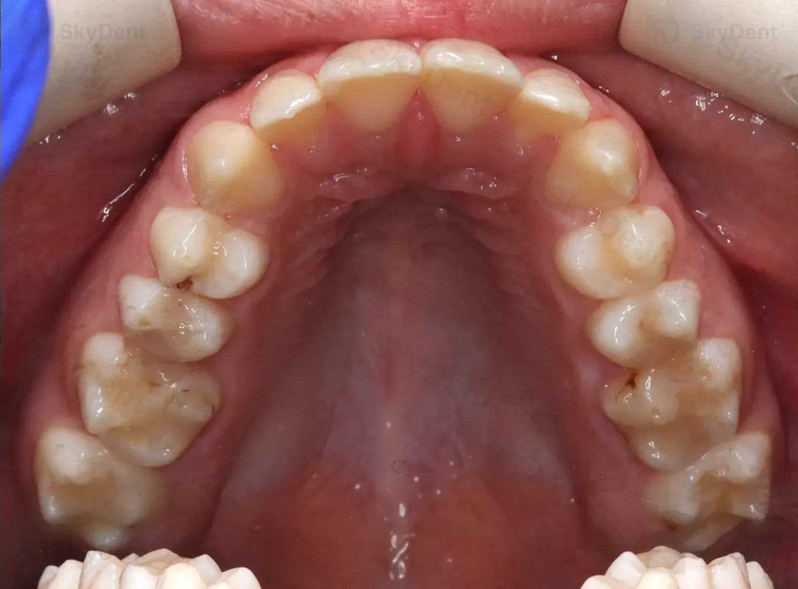 Łuk górny przed leczeniem zgryzu otwartego na mikroimplantach — Wrocław SkyDent