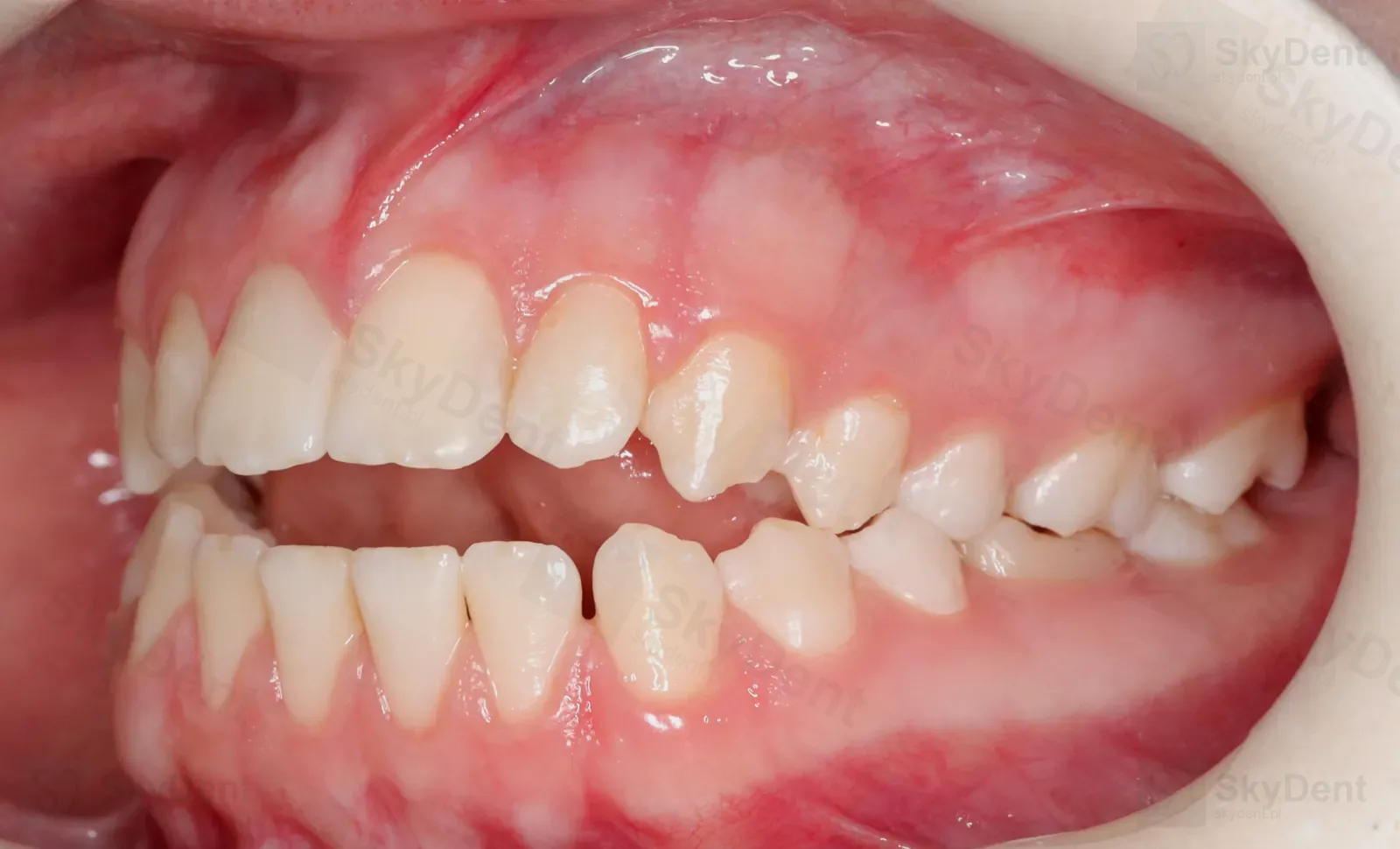 Ujęcie z lewej przed leczeniem zgryzu otwartego na mikroimplantach — Wrocław SkyDent