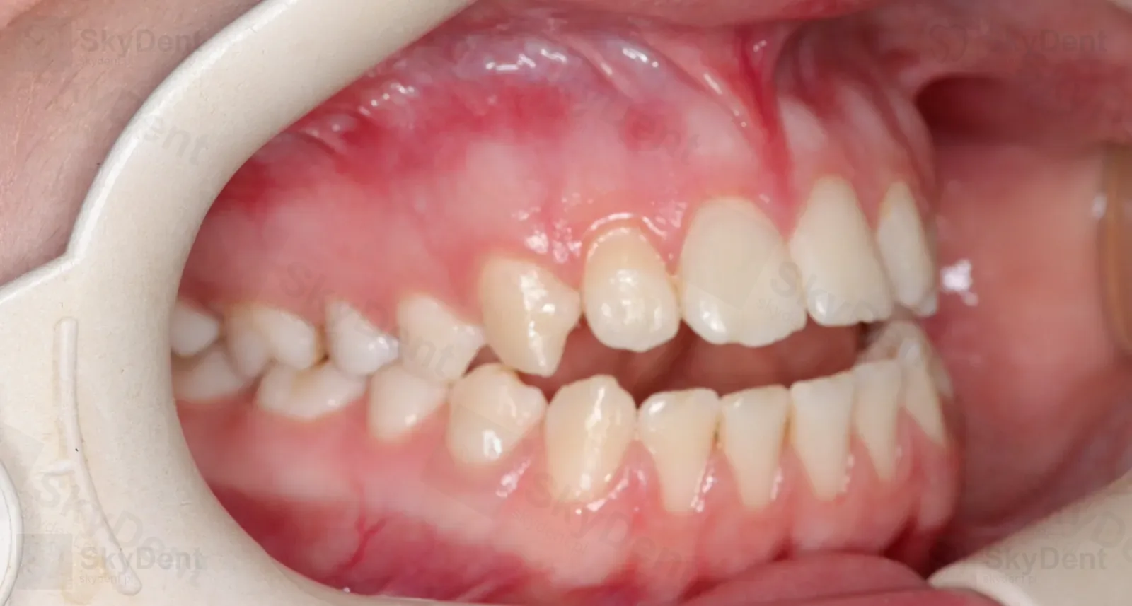 Ujęcie z prawej przed leczeniem zgryzu otwartego na mikroimplantach — Wrocław SkyDent