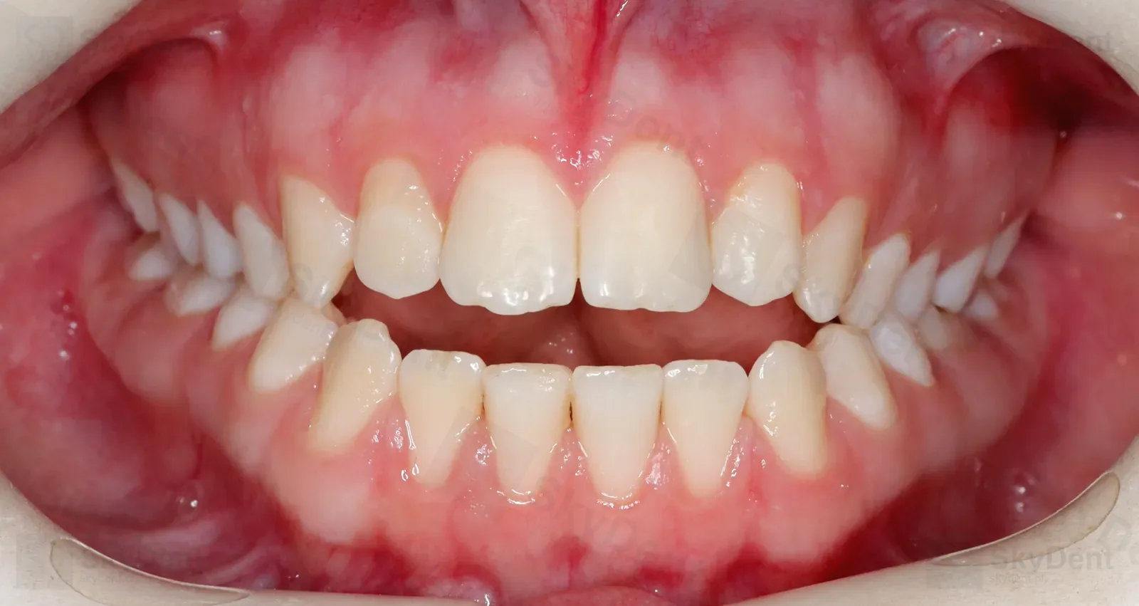 Zgryz otwarty przed leczeniem na mikroimplantach TAD — brak kontaktu siekaczy, Wrocław SkyDent
