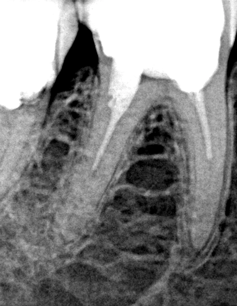 RTG zęba 46 przed reendo pod mikroskopem we Wrocławiu – niedopełnione kanały