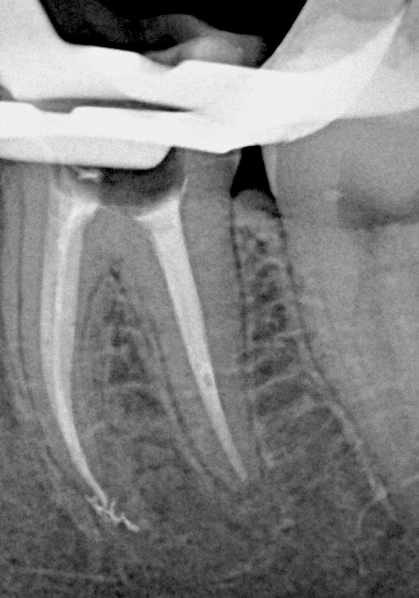 RTG zęba 36 po re-endodoncji pod mikroskopem – wszystkie kanały hermetycznie wypełnione